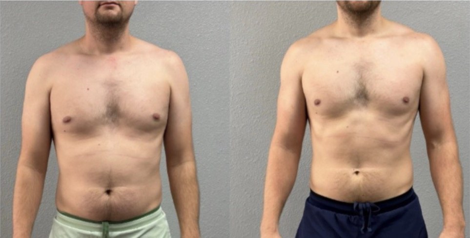 Transformación de Mateo, 6kg perdidos + masa muscular